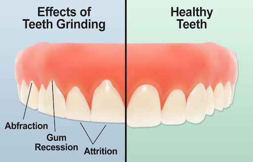 Bruxism | Lullaby Sleep